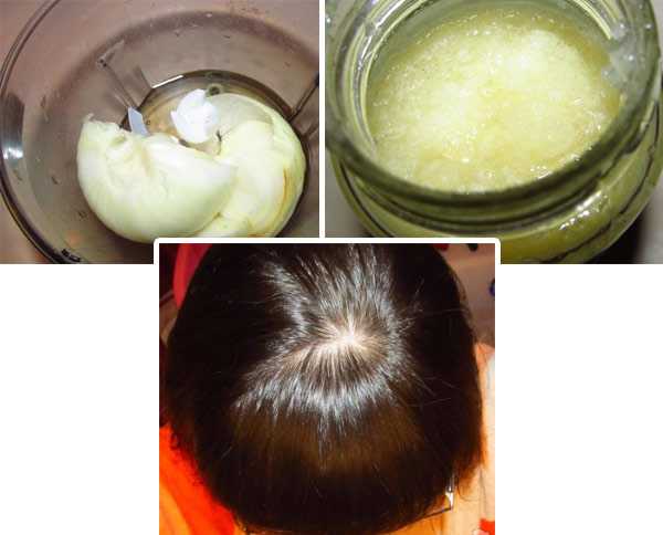 Эффективные средства для роста волос: полезные луковые маски, рецепты с соком и шелухой растения. луковая маска для волос против выпадения