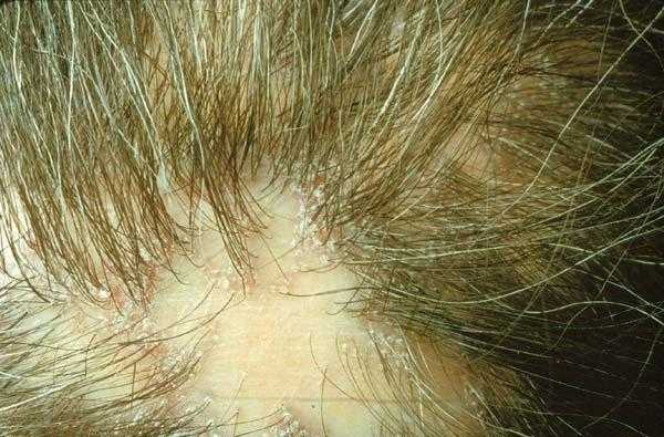 Формы проявления и методы лечения лишая у ребенка на голове в волосах