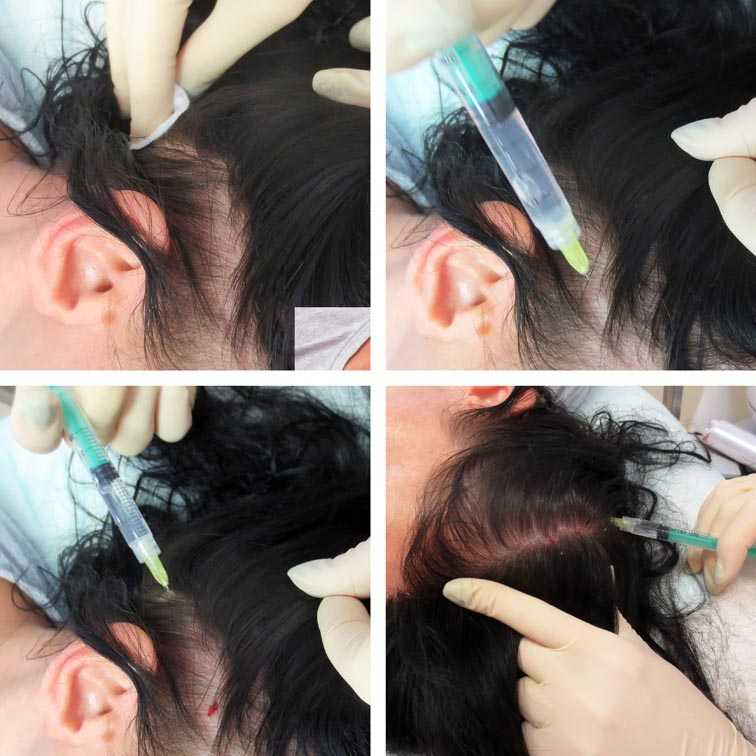Мезотерапия для волос для мужчин, женщин. как делать мезотерапию для волос дома?