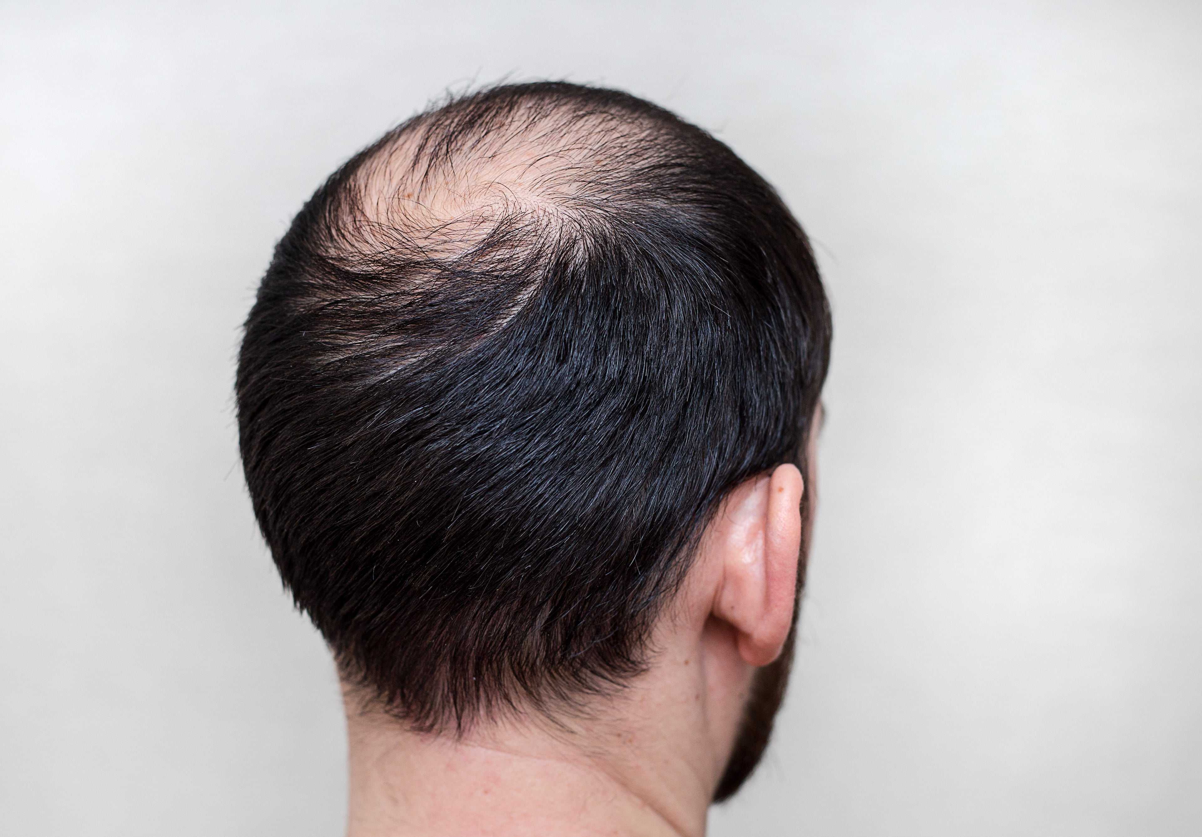Средство от лысины у мужчин. народные средства от облысения. средство против выпадения волос: нужно ли оно вам?