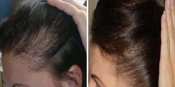 Гормоны и здоровье волос, часть 2: андрогенетическая алопеция у женщин