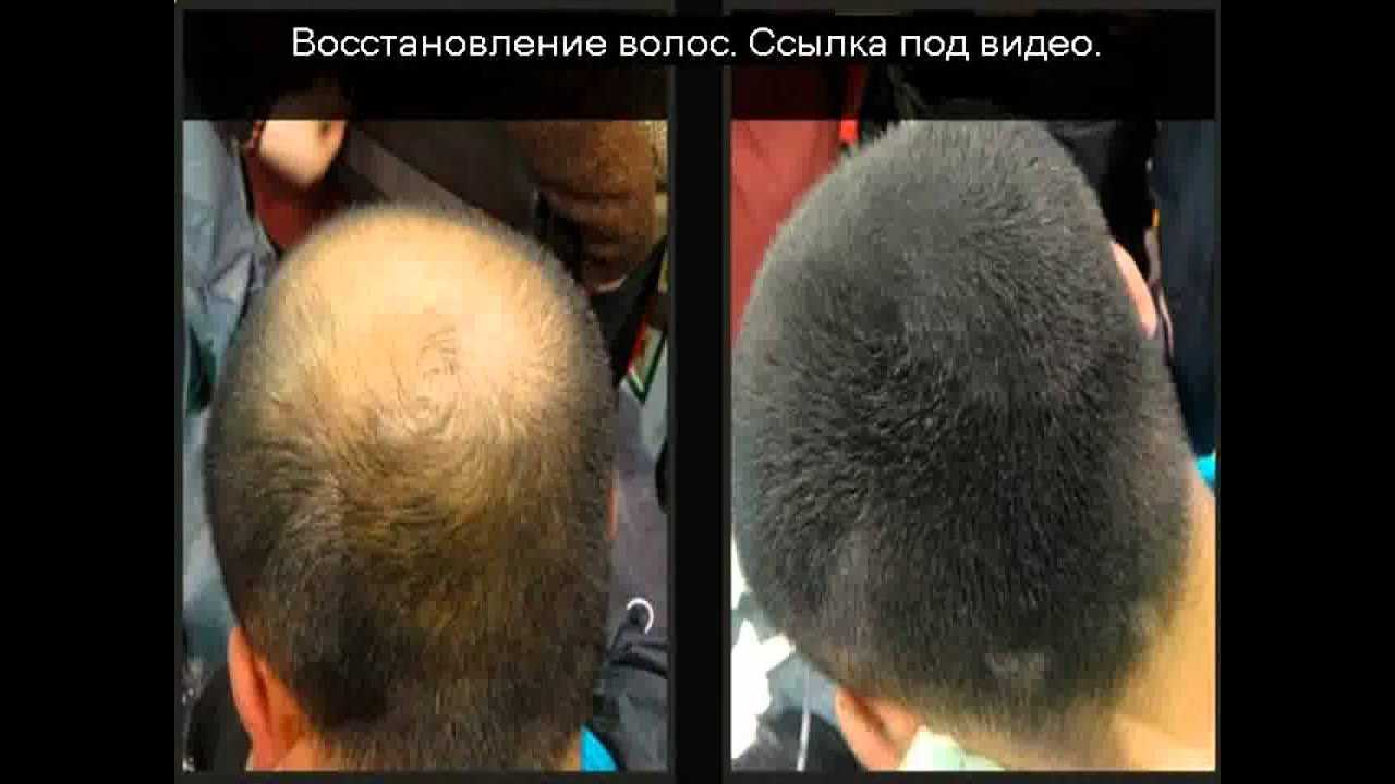 Как быстро восстановить волосы после. Волосы после химиотерапии. Средства для восстановления волос после химиотерапии. Восстановление волос после химиотерапии. Рост волос после химиотерапии.