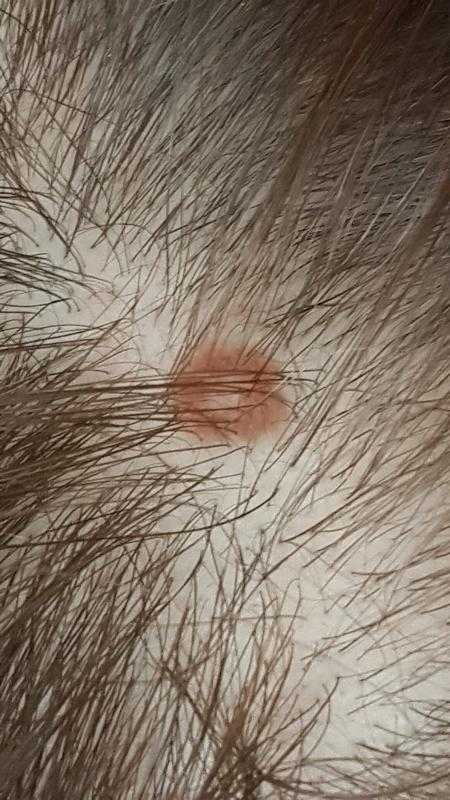 Болезни кожи головы: виды, симптомы, методы лечения