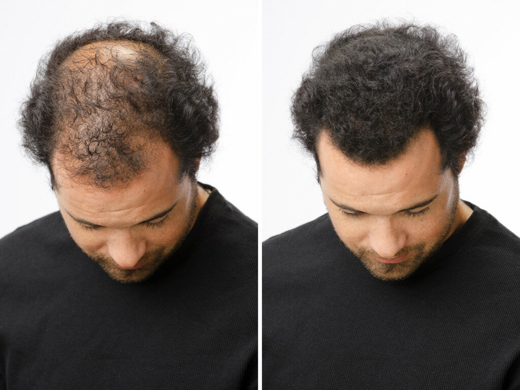 Разбираемся в основных причинах и лечении ломких волос