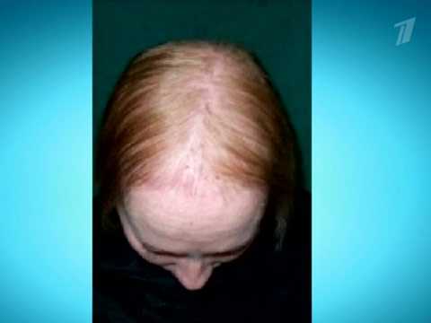 Почему выпадают волосы после хирургического вмешательства и можно ли их вернуть к прежнему состоянию?
