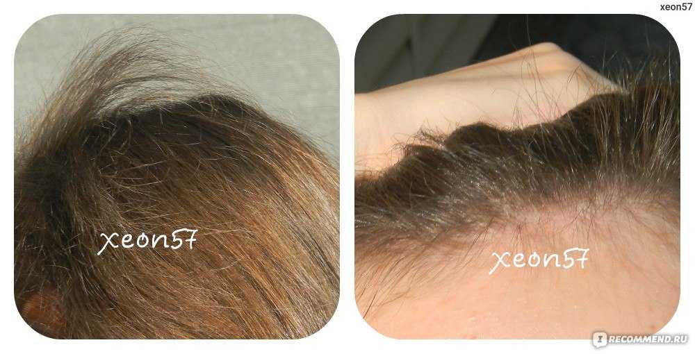 Как быстро восстанавливаются волосы после выпадения