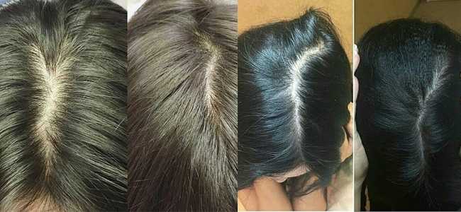 Мезотерапия (уколы) для роста волос: противопоказания и какой эффект от процедуры, цена, фото до и после