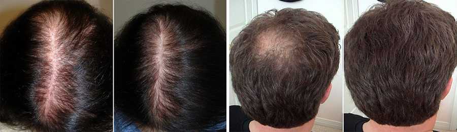 Секреты мезотерапии для волос: какого эффекта ждать?
