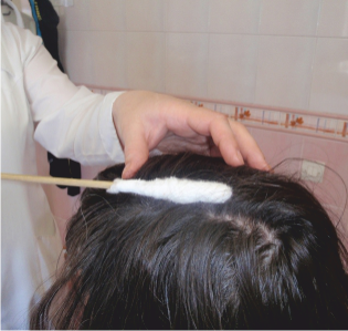 Криотерапия кожи лица и волосистой части головы