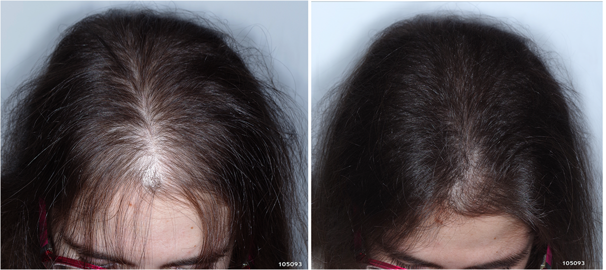 Топ 5 методов, которые просто решат проблему выпадения волос