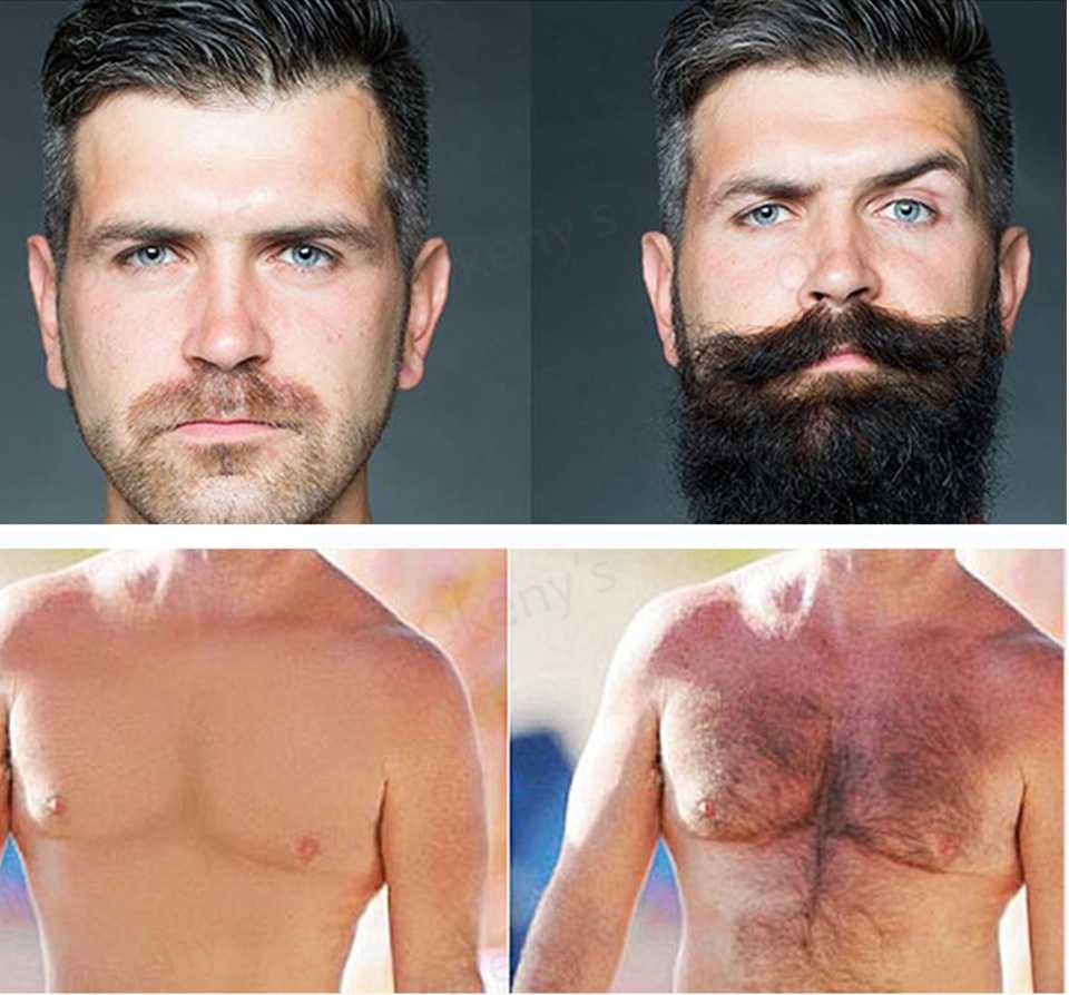 Выпадают волосы на бороде: что делать и как лечить?