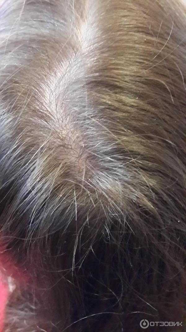 Псориаз волосистой части головы: лечение и обзор препаратов