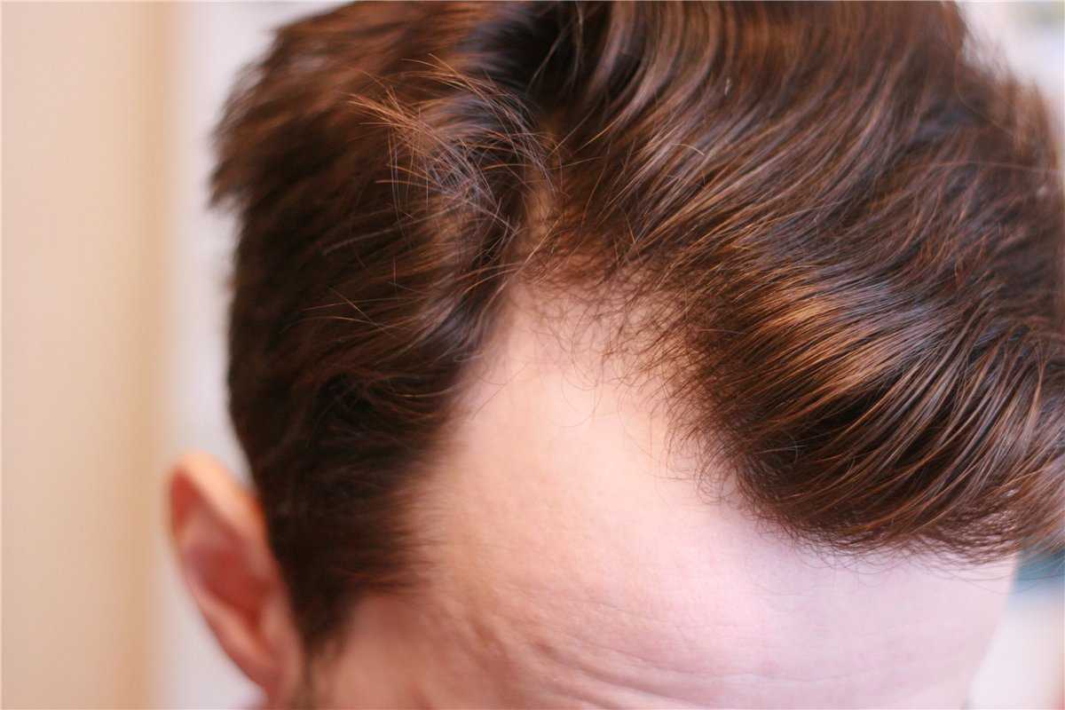 Что делать если волосы растут в разные стороны на голове