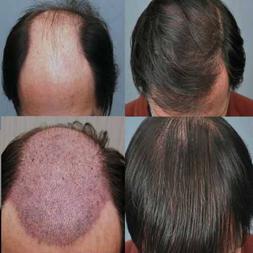 Диффузное выпадение волос у женщин – причины, а также средства и способы лечения народными средствами