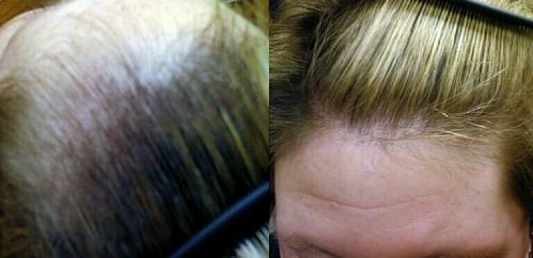 «миноксидил» для волос — лечение андрогенного облысения