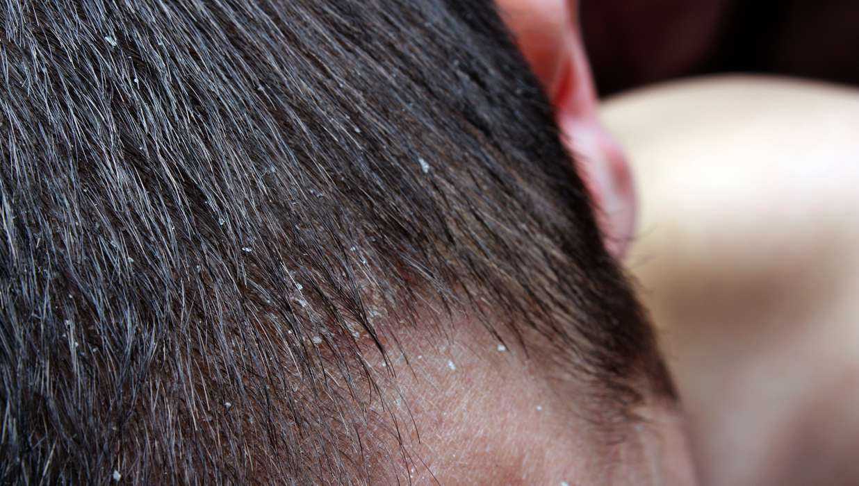Как лечить корки на голове под волосами у взрослого?