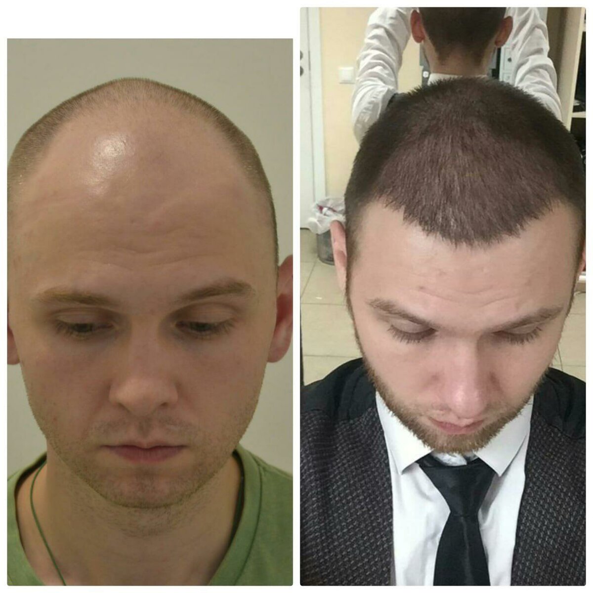 Методы пересадки волос на голове для мужчин и женщин. как проходит операция, hfe, цены клиник, результаты, фото