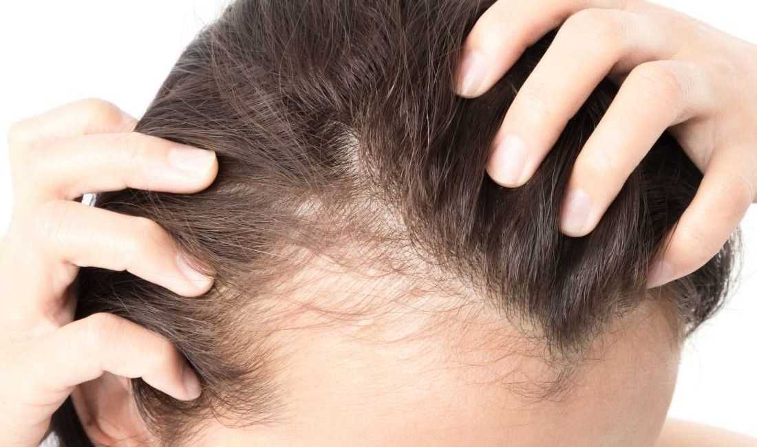 Как остановить выпадение волос у женщин?