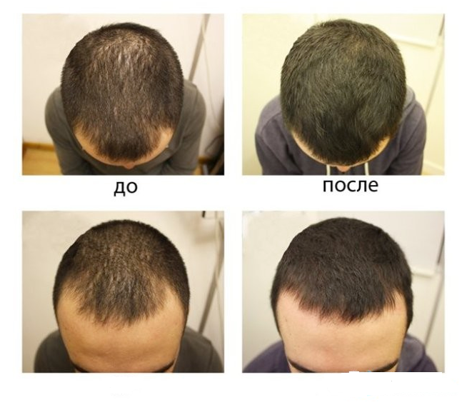 Генеролон спрей – эффективное средство для роста волос