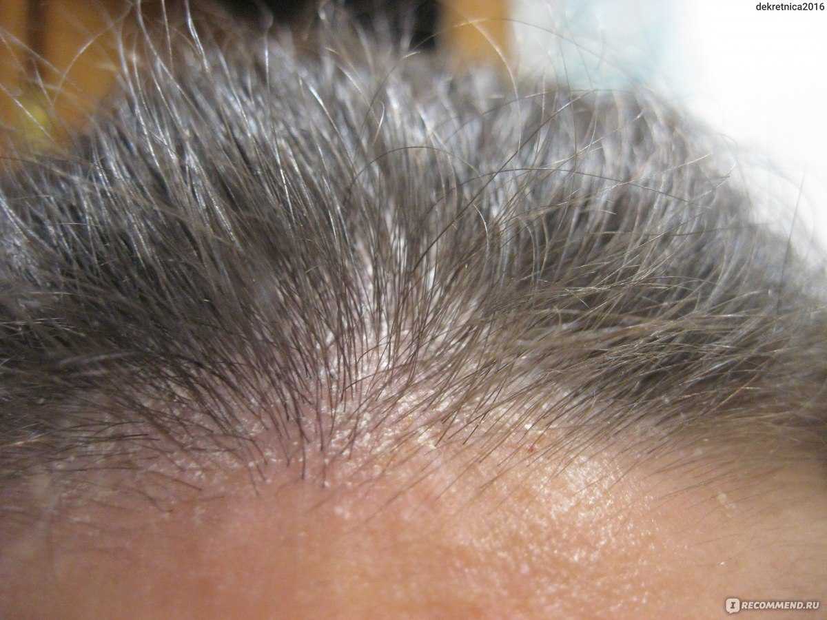 Шелушится кожа на голове — советы дерматологов по лечению и профилактике