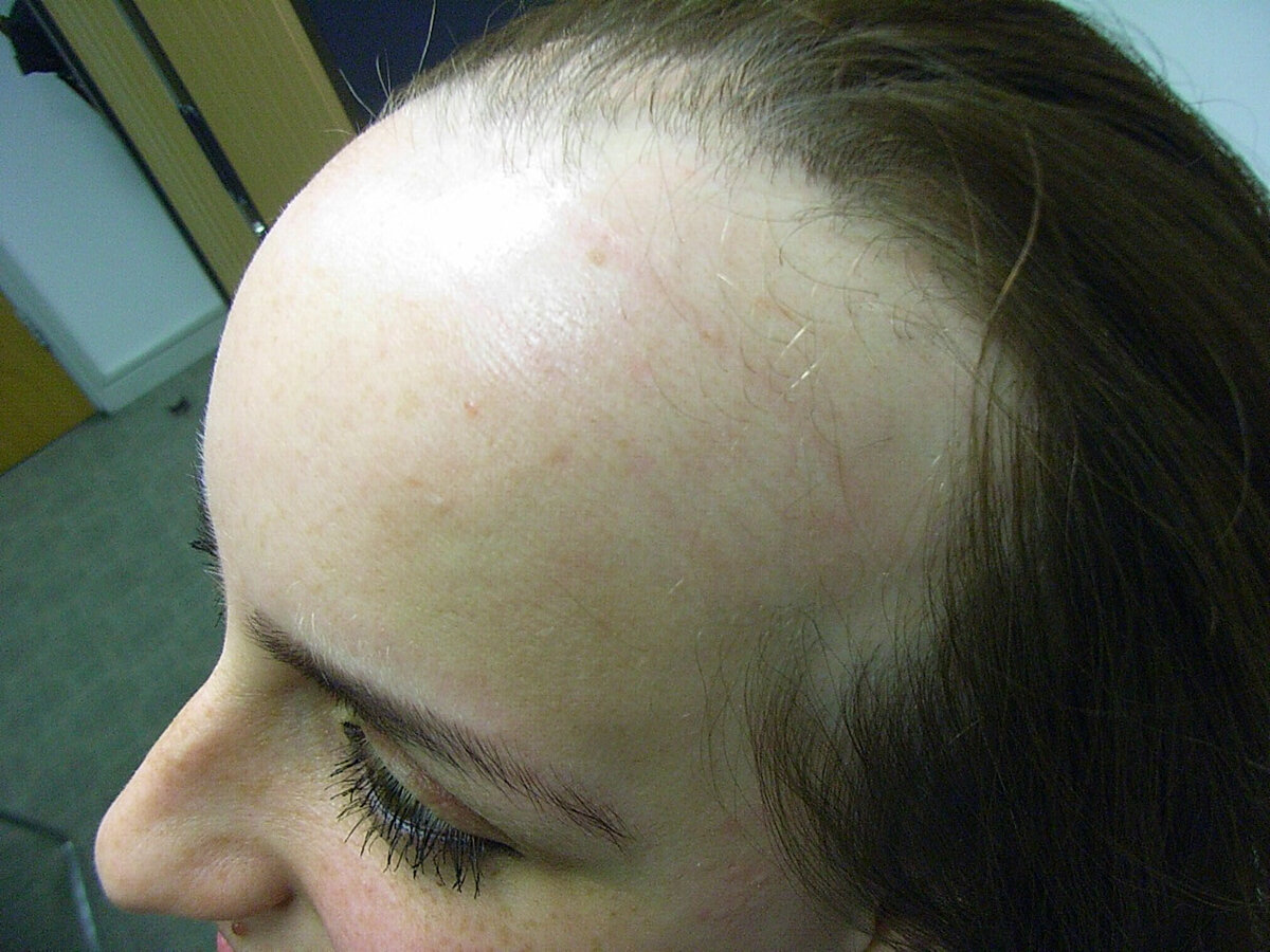 Аутоиммунная алопеция – причины выпадения волос и лечение