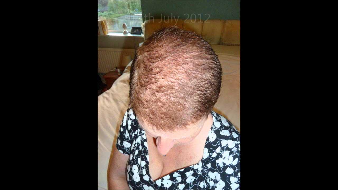 После какой химиотерапии начинают расти волосы. волосы после химиотерапии. при всех ли видах химиотерапии выпадают волосы?