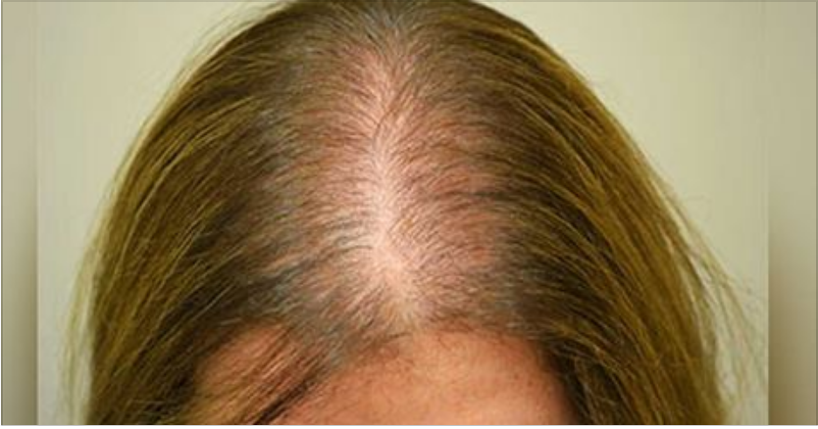 Гормоны и здоровье волос, часть 2: андрогенетическая алопеция у женщин