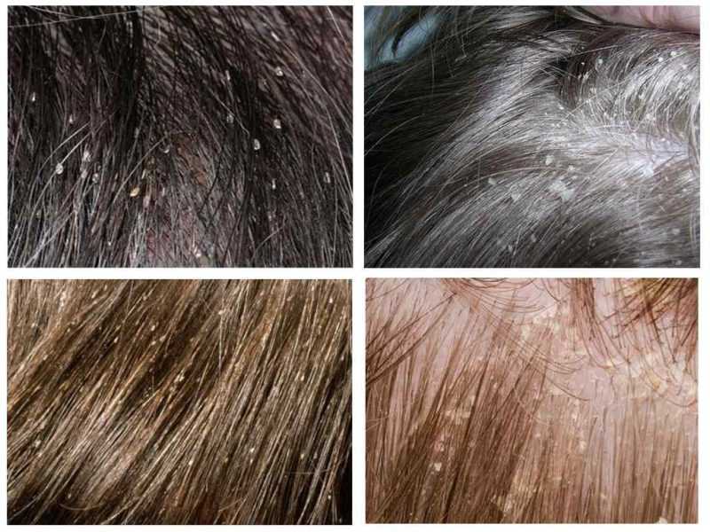 Сухая себорея кожи головы: лечение в домашних условиях, шампуни, другие .