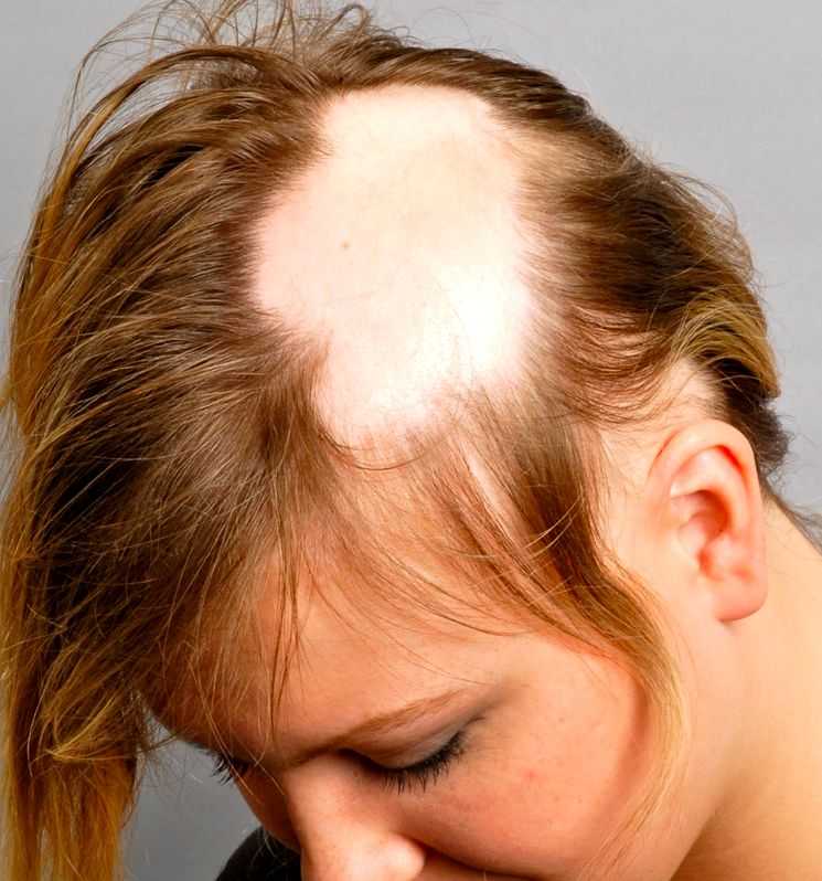 Почему появляются залысины на лбу у женщин, как справиться с выпадением волос