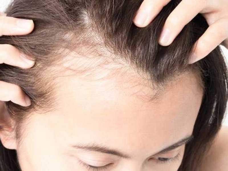 По каким причинам могут выпадать волосы у женщин?