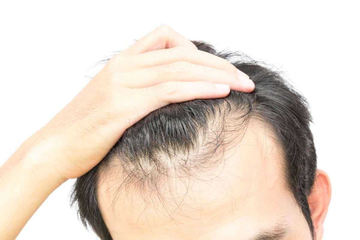 Выпадение волос у мужчин. причины, средства, профилактика