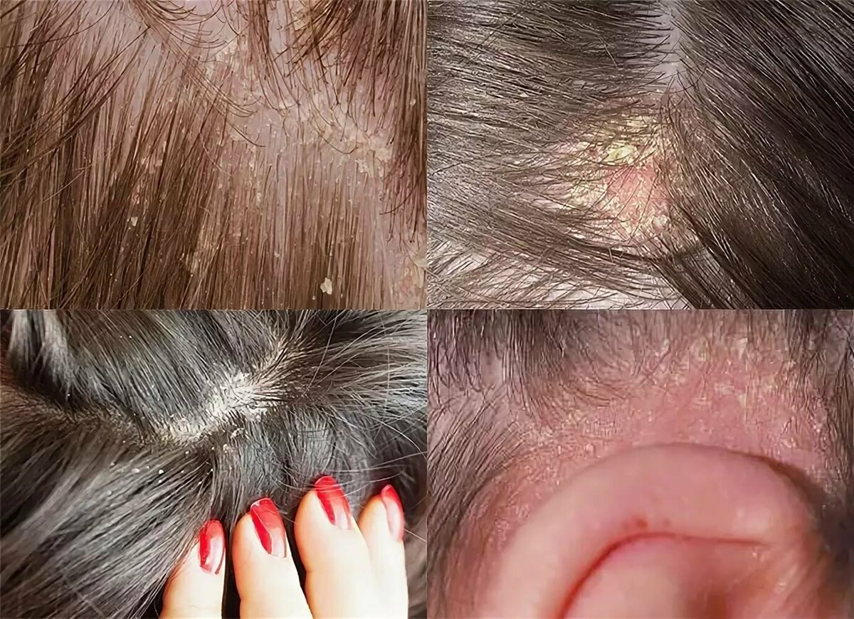 Псориаз волосистой части головы: все о лечении (15 шампуней, 9 мазей, маски, таблетки), причины, симптомы