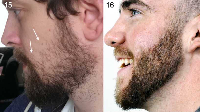 Как ускорить рост бороды — рассказывают эксперты