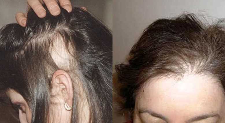 Выпадение волос после родов – 4 лечебных маски для волос