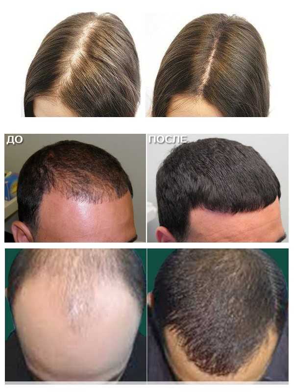 Мезотерапия (уколы) для роста волос: противопоказания и какой эффект от процедуры, цена, фото до и после