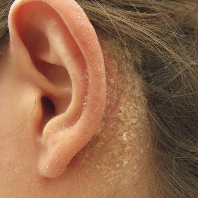 Почему шелушатся уши: причины и методы лечения