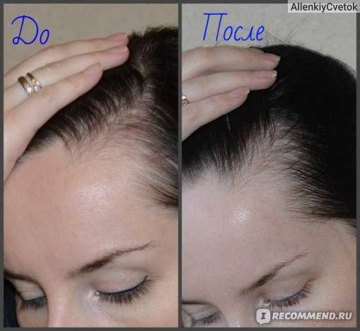 Никотиновая кислота для роста волос: применение, рецепты маски