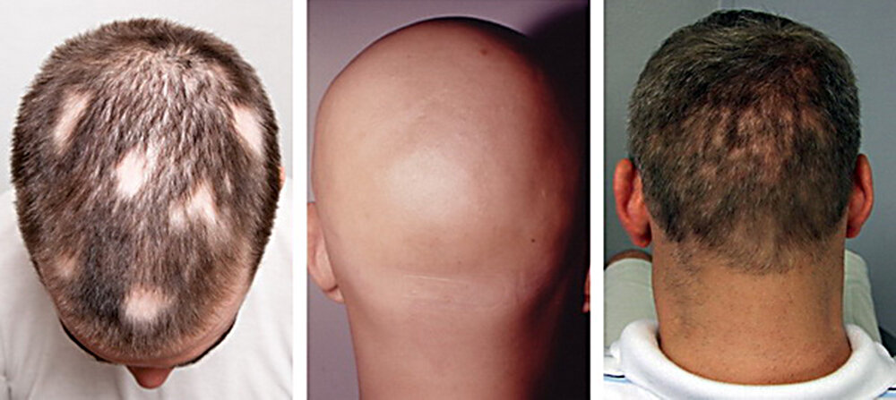 Диффузная алопеция (телогеновое выпадение волос): что это такое, лечение у женщин и мужчин, фото, отзывы, витамины от облысения негормональной этиологии