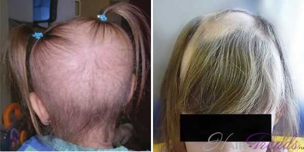 После родов выпадают волосы: почему это происходит и как восстановить здоровые локоны?