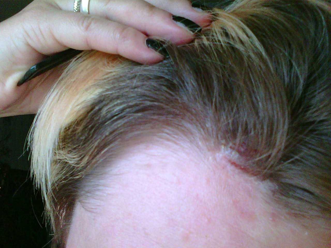 Шелушится кожа на голове — советы дерматологов по лечению и профилактике