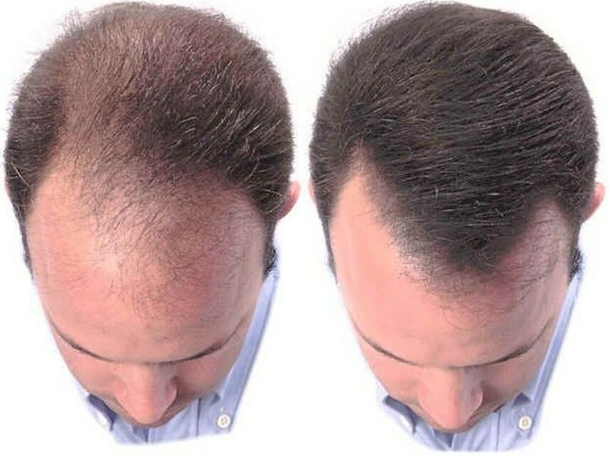 Средства для восстановления волос у мужчин: обзор 8 лучших