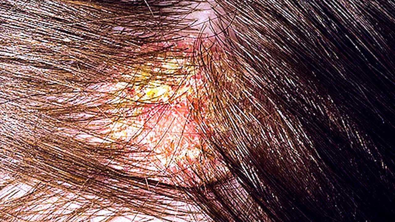 Болезни кожи головы: виды, симптомы, методы лечения