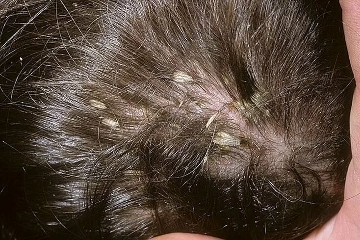 Почему появились болячки в волосах на голове? основные причины и лечение у взрослых и детей