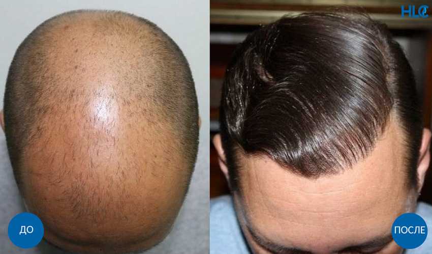 Как вернуть волосы на голове у мужчин?