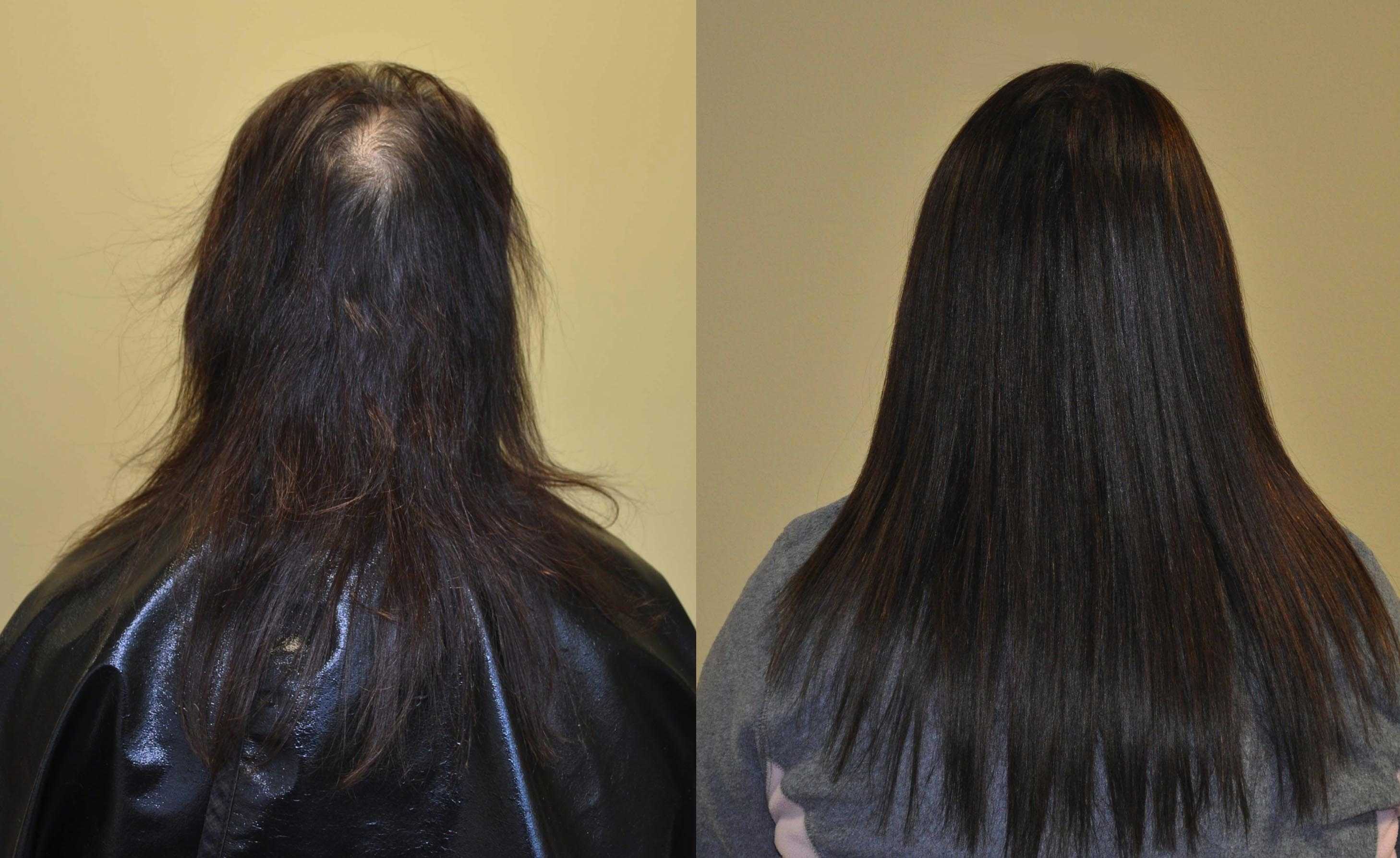 Выпадают черные волосы. Микрокапсульное наращивание волос при алопеции. Наращивание волос до и после. Нарощенные волосы до и после. Загущение волос наращиванием.