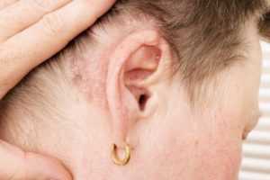 Ушная перхоть: причины появления, симптоматика и способы устранения косметического дефекта