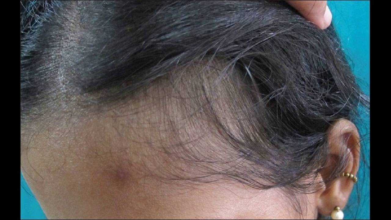 Почему выпадают волосы у женщин? [7 причин]