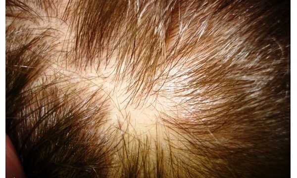 Волосяной лишай на голове: фото различных видов (отрубевидный, красный), лечение, видео