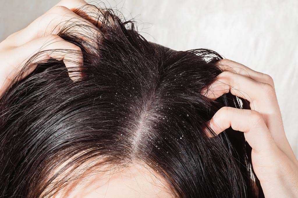 Выпадают волосы от стресса: что делать?