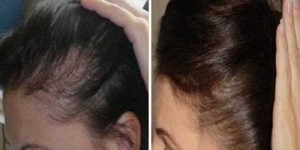 Особенности мезотерапии для волос